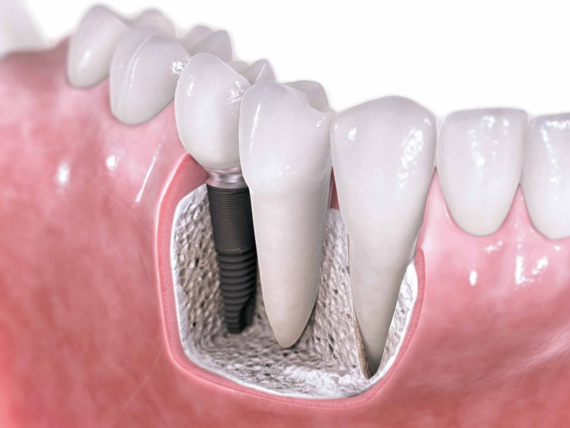 Transform Your Smile with Denture Implants in Clackamas, OR