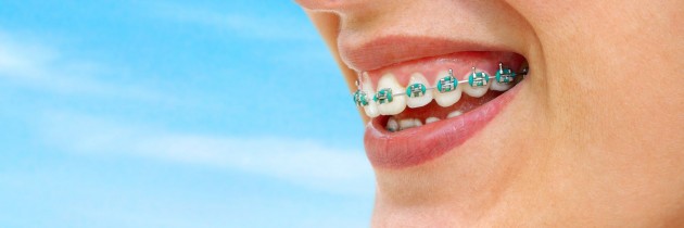 Keeping Your Teeth Straight After Orthodontic Care in Queens NY