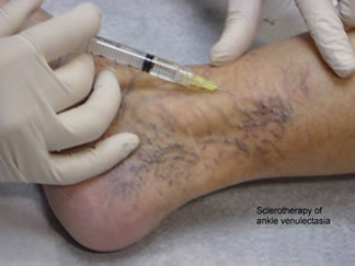 Understanding Varicose Veins Treatment In The Bay Area