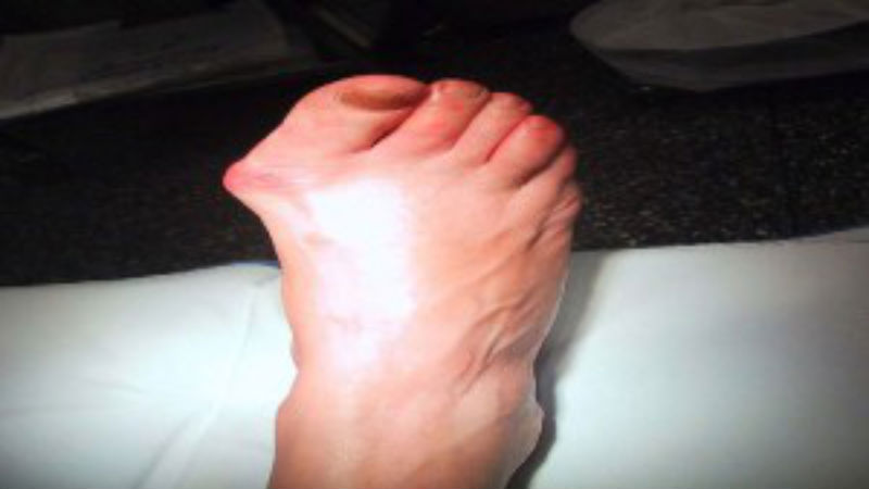 Get Back On Your Feet Again With Bunion Surgery