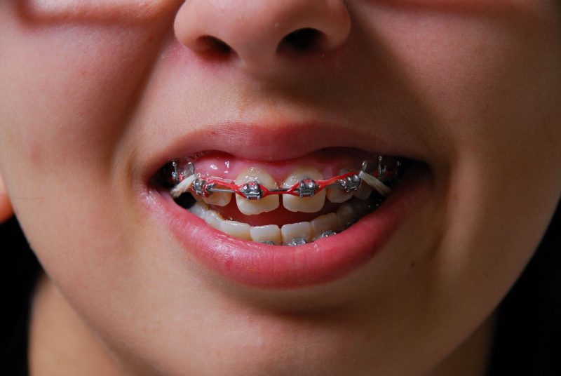 Useful Details Concerning Dentures in Kona