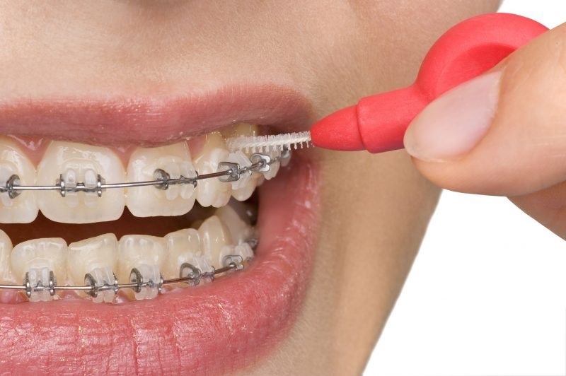 Do You Need Teeth Braces in Toms River, NJ?