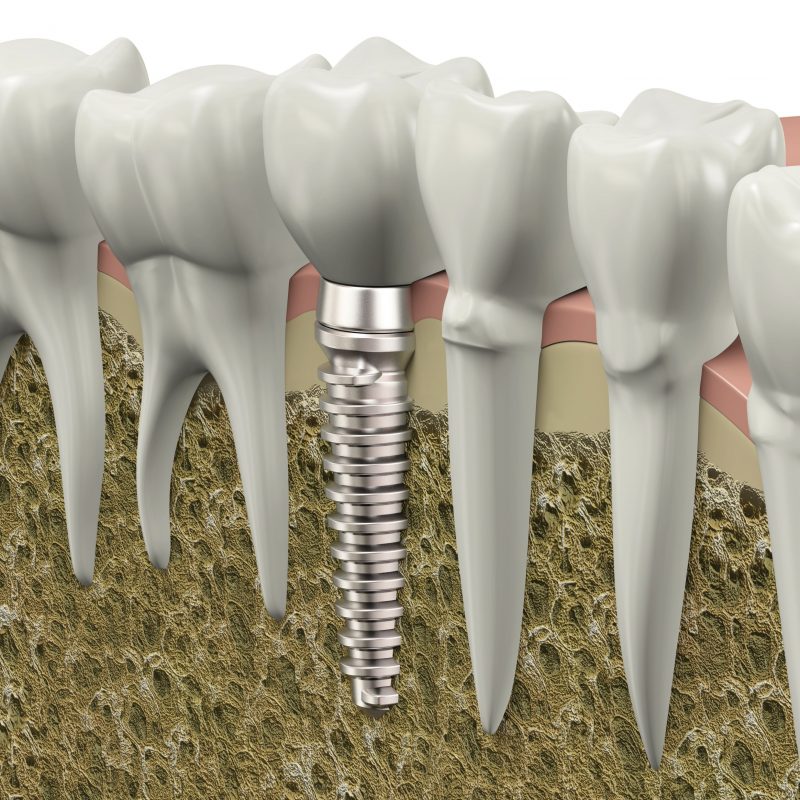 Information to Understand Concerning Dental Implant Services Granite in Quarry NC