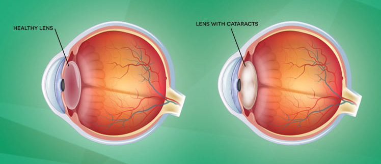 What Cataract Treatment Options Are Available?
