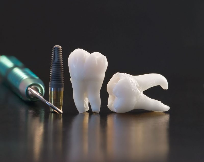 Getting Dental Implants? 4 Questions to Help You Decide