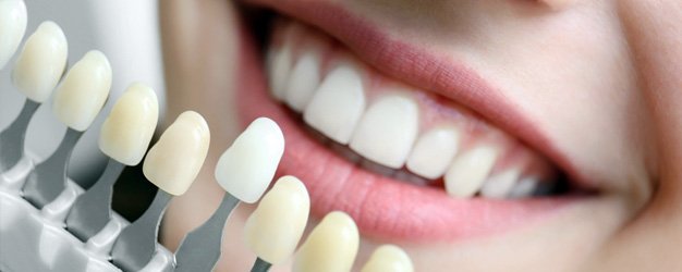 The Benefits of Porcelain Veneers in Del City OK