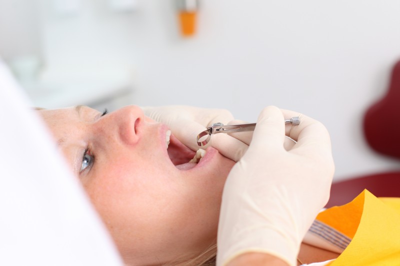 Tips on How to Heal From Teeth Extractions in Hoffman Estates