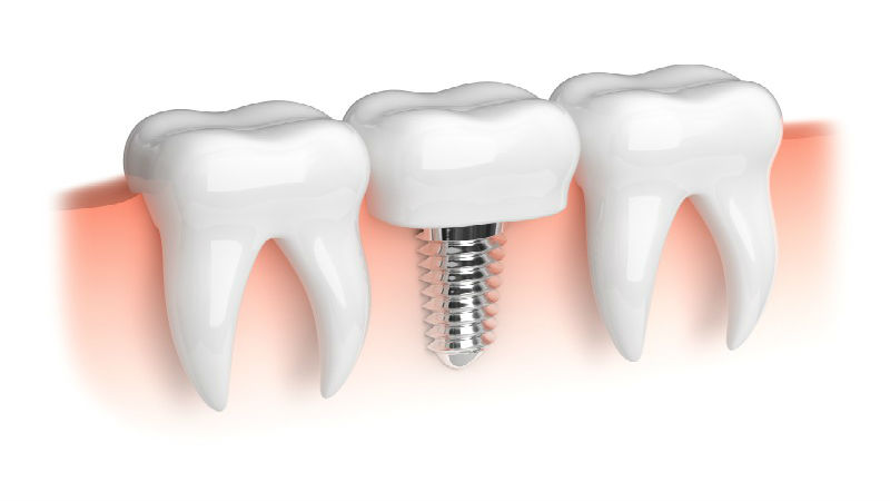 Uncover Lasting Smiles with Dental Implants in Dana Point, CA for Confident Everyday Living