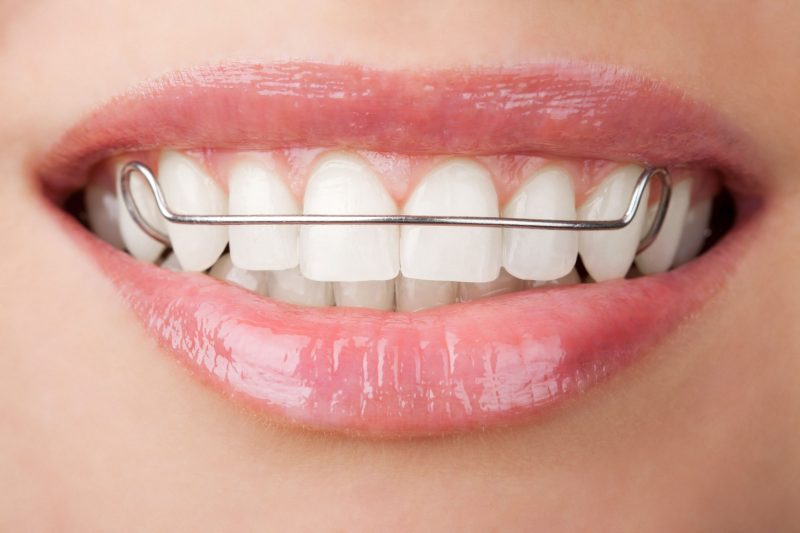 The cost and benefits of Invisalign