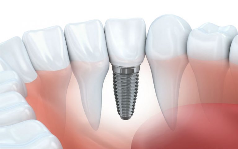 Improve your Smile with Dental Implants in Fairfield County CT