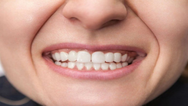 Make Your Smile Whole with Teeth Implants in Macon, GA