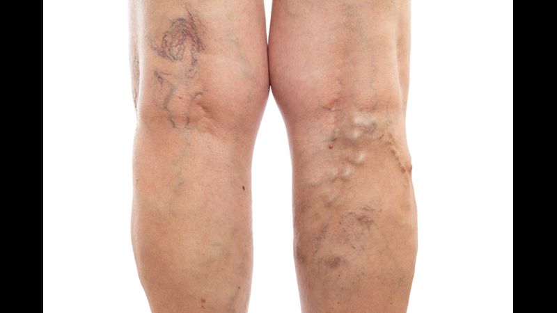 How Vein Clinic in Bensalem PA can ease your Pain