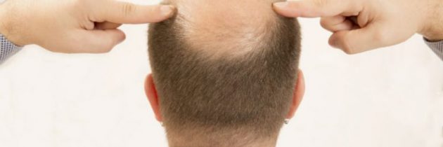 What You Should Know When Considering Hair Restoration in NYC