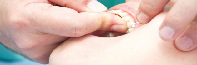Dental Implant: What You Need to Know