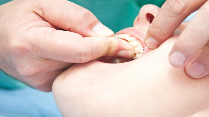 Dental Implant: What You Need to Know