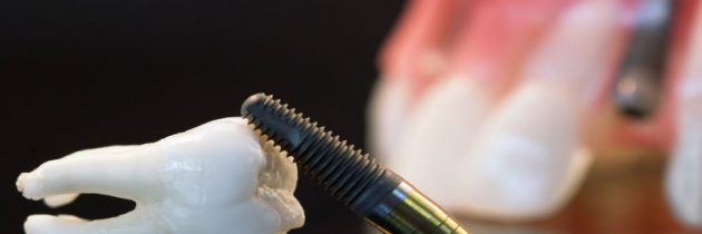 Getting Dental Implants in Miami Lakes Can Improve Your Dental Health