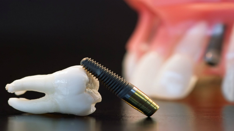 Getting Dental Implants in Miami Lakes Can Improve Your Dental Health