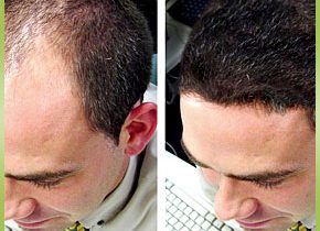 4 Advantages Of Having Hair Transplantation In Fort Lauderdale, FL