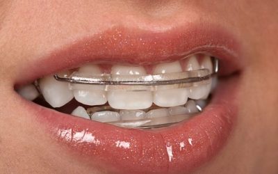 Why Braces In Strongsville OH Are An Ideal Solution