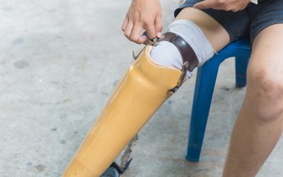 Life Improvements Achieved With a Prosthetic Arm Twin Falls ID Users Can Rely On